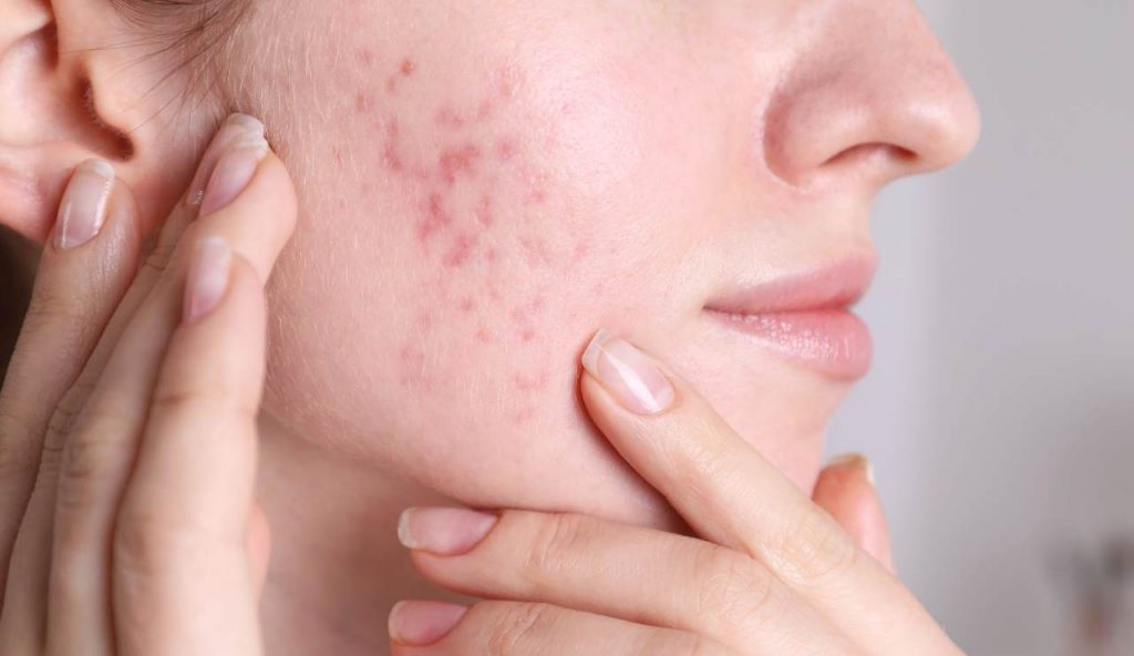 Scoperto il virus che cura l’acne I Realizzato l’innovativo prodotto per dire addio a questa fastidiosa condizione cutanea